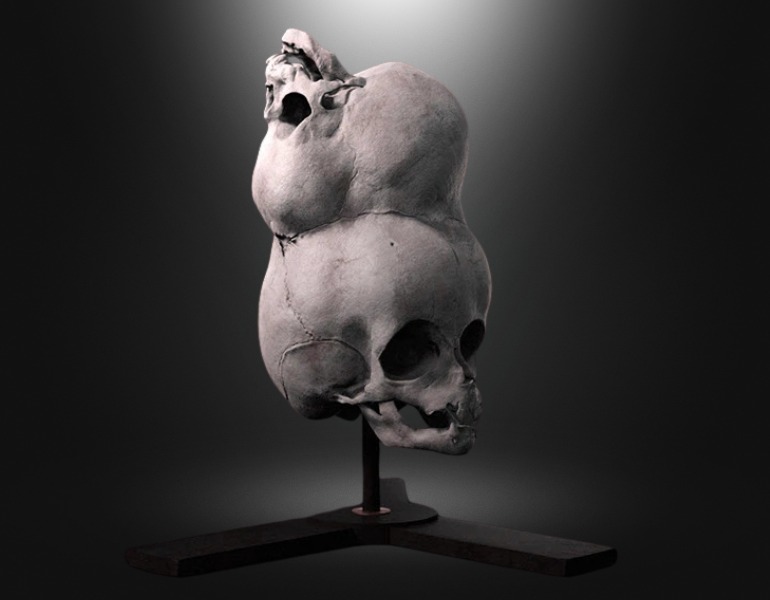 Le crâne est aujourd'hui conservé dans un musée londonnien